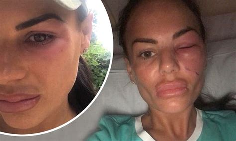 Chantelle Connelly Ends Up In Hospital From A Spider Bite Daily Mail