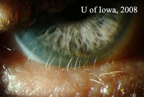 Case Distichiasis Extra Eyelashes EyeRounds Org Ophthalmology The University Of Iowa