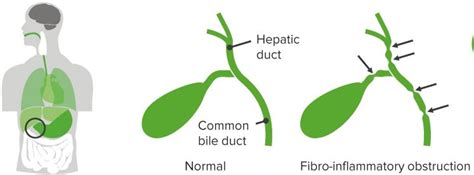 Maybe you would like to learn more about one of these? Pediatric Biliary Atresia — Diagnosis and Surgery