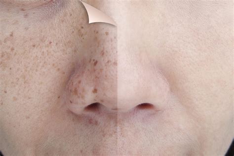 What Is The Cost For Laser Skin Resurfacing Utah Facial Plastics