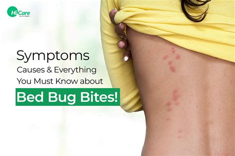 Bed Bugs Bite Symptoms Diagnosis And Treatment HiCare