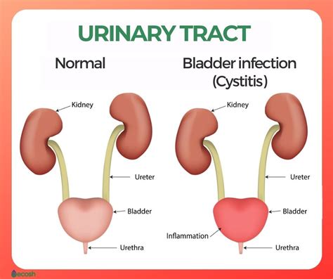 Urinary Tract Infection Cystitis Bladder Highlighted On The My Xxx Hot Girl