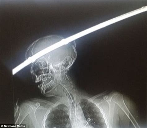 Indian Man Survives Being Impaled By An Iron Rod That Went Through His Brain In