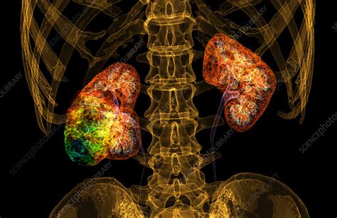 Kidney Cancer 3d Ct Scan Stock Image C0490102 Science Photo Library