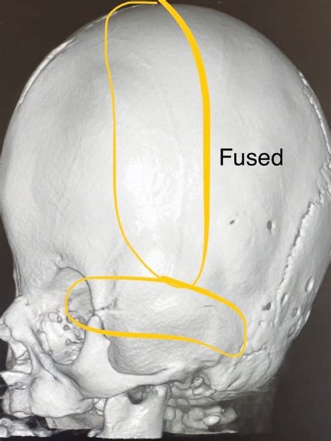 Surgeons Will Remove And Then Reconstruct A Large Part Of Daisys Skull