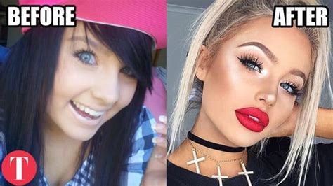 Plastic Surgery Before After Instagram