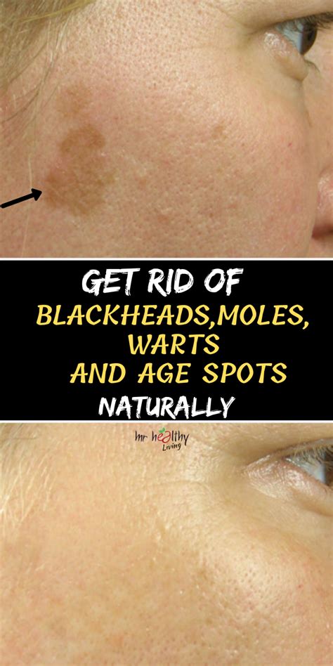 Get Rid Of Blackheads Moles Warts And Age Spots Naturally Brown