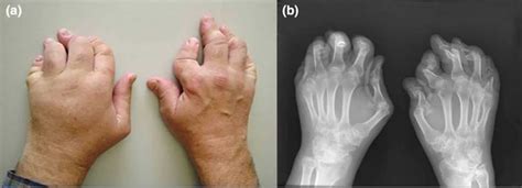 Psoriatic Arthritis Mutilans And Arthritis Mutilans Treatment