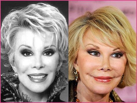 Celebrity Plastic Surgery Disasters Photo 1 Pictures Plastic