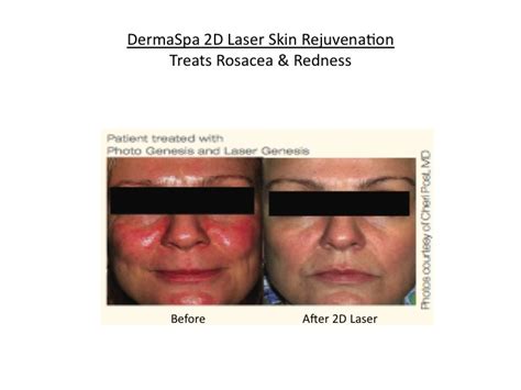 Rosacea Redness And Facial Veins