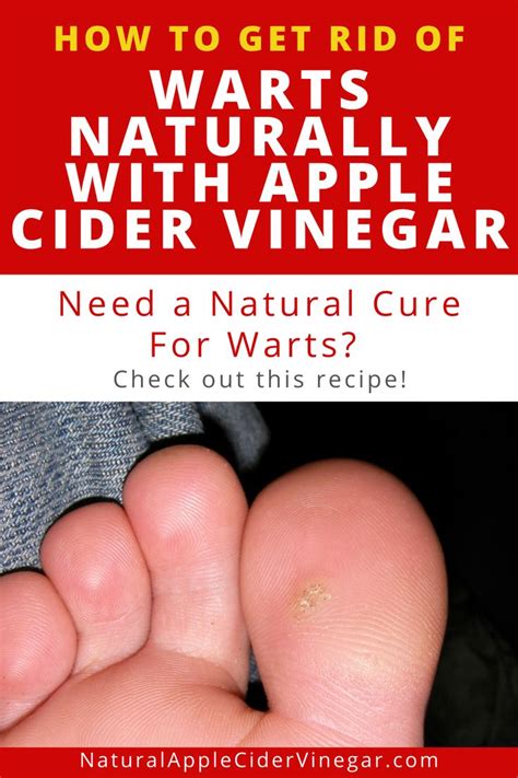 How To Get Rid Of Warts Naturally With Apple Cider Vinegar All