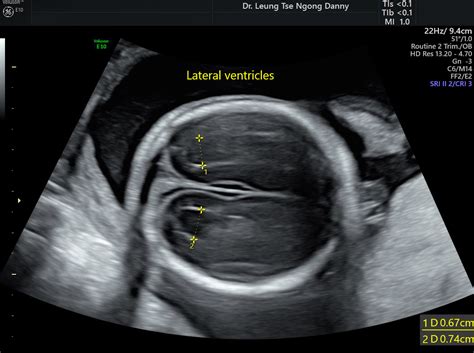 Lateral Ventricles Fetal Brain Ultrasound