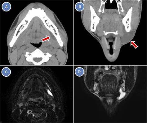 Submandibular Gland Mucocele Masquerading As Plunging Ranula Satomi