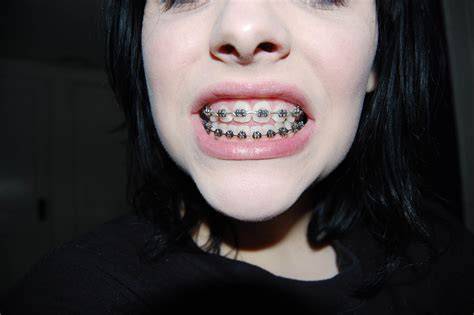 Bros Lifestyle Guide To Adult Braces Bro Blog