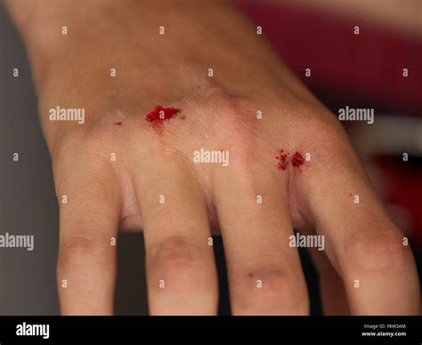 Injured Bleeding Hand Stock Photo Alamy