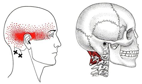 Neck Headaches Aka Cervicogenic Headaches Everything You Need To Know