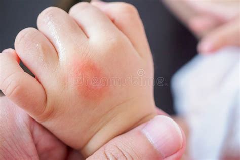 Severe Eczema Skin Rash And Allergic Reaction Symtom At Little Asian