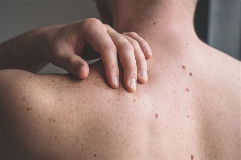 Understanding The Moles On Your Skin Swinyer Woseth Dermatology