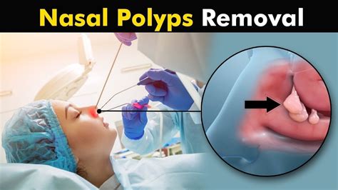 Facts About Nasal And Nasal Polyps Nasal Cavity Sciencefacts