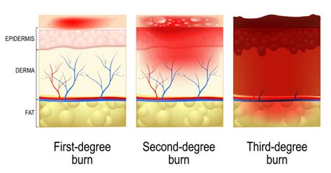 Thermal Burns Background And Pathophysiology Medical Exam Prep