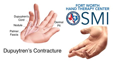Dupuytrens Contracture Fort Worth Hand Therapy Center
