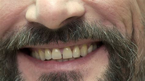 Smile Of A Bearded Man Smiling Mouth Close Up Tips For Healthy Teeth