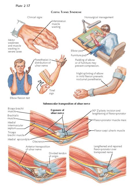 Cubital Tunnel Syndrome Pediagenosis