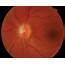 Typical And Atypical Optic Neuritis – Diagnosis Initial Management 