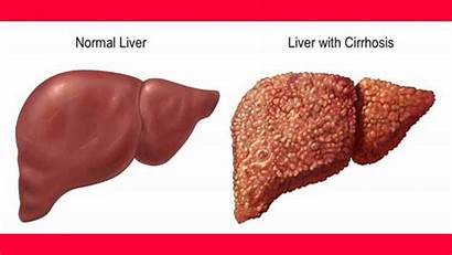 Liver Fatty Fix Health Types Shocking Truth