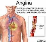 Angina Throat Treatment