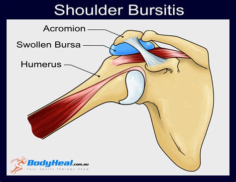 Shoulder Bursitis And Tendonitis