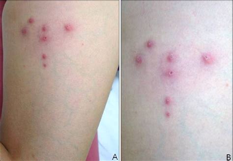 Figure 1 From A Case Of Furuncular Cutaneous Myiasis After Traveling To Cameroon Semantic Scholar