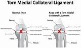 Knee swelling and bruising are common, and grade i mcl sprain recovery time. MCL Tear Treatment Burr Ridge, Plainfield & Morris, IL ...