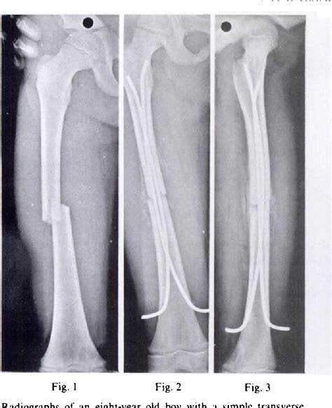 Figure 1 From Elastic Stable Intramedullary Nailing Of Femoral Shaft