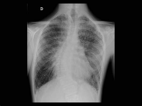 Subpleural Lung Cysts Associated To Down Syndrome Eurorad