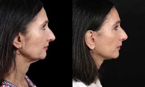 Beautiful Natural Facelift Results In San Diego By Expert Plastic