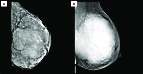 Mammography Findings Are Suggestive Of Breast Cancer With Metastatic