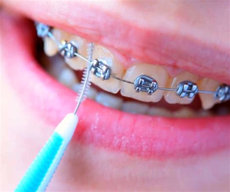 Cleaning Your Teeth With Braces Specialist Orthodontics Treatment