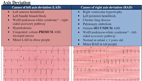 Right axis deviation (rad) involves the direction of depolarisation being distorted to the right (between +90º and +180º). MEDICINE PAKISTAN: Causes of Axis Deviation on ECG