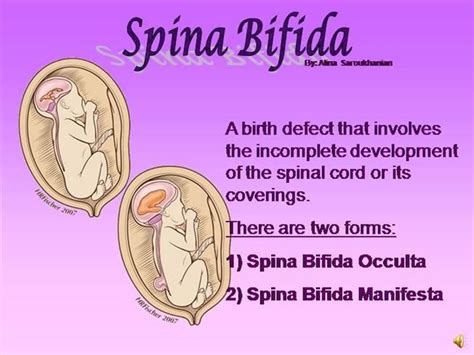 pin on spina bifida myelomeningocele