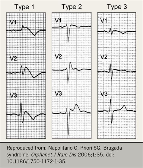 Brugada Syndrome In The Context Of A Fever A Case Study And Review Of