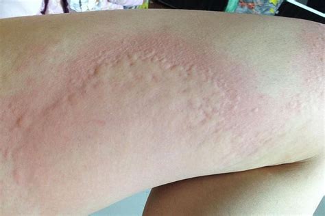 Hives Common Rash With Many Possible Causes Urticaria Allergy