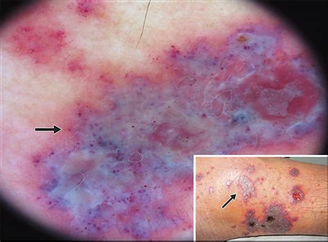 Dermoscopic Patterns Of Purpuric Lesions Dermatology Jama