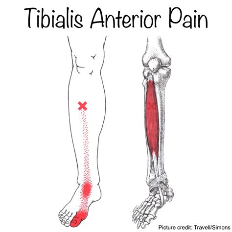 Tibialis Posterior Trigger Point Runner S Achilles Tendonitis Hot Sex