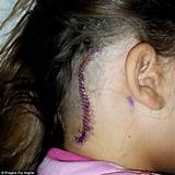 After Brain Tumour Surgery Side Effects Photos