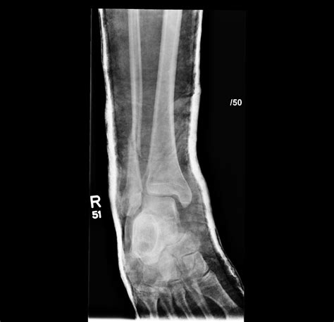 Ankle Antrim Ed Meducation