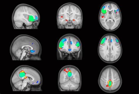 Brain Networks Diverge In Autism By Toddlerhood Spectrum Autism