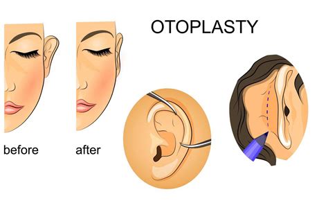 Ear Surgery Otoplasty Ear Pinning In Turkey Up To Off Medaway