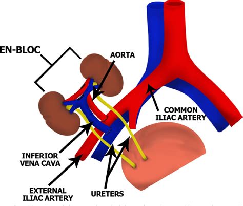 Figure 2 From Expanding Opportunities For Kidney Transplantation