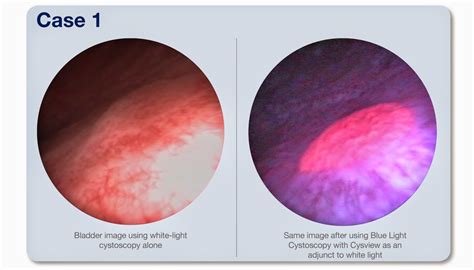 Brady Urology At Johns Hopkins Hospital Fluorescence Cytology Cysview For Bladder Cancer A